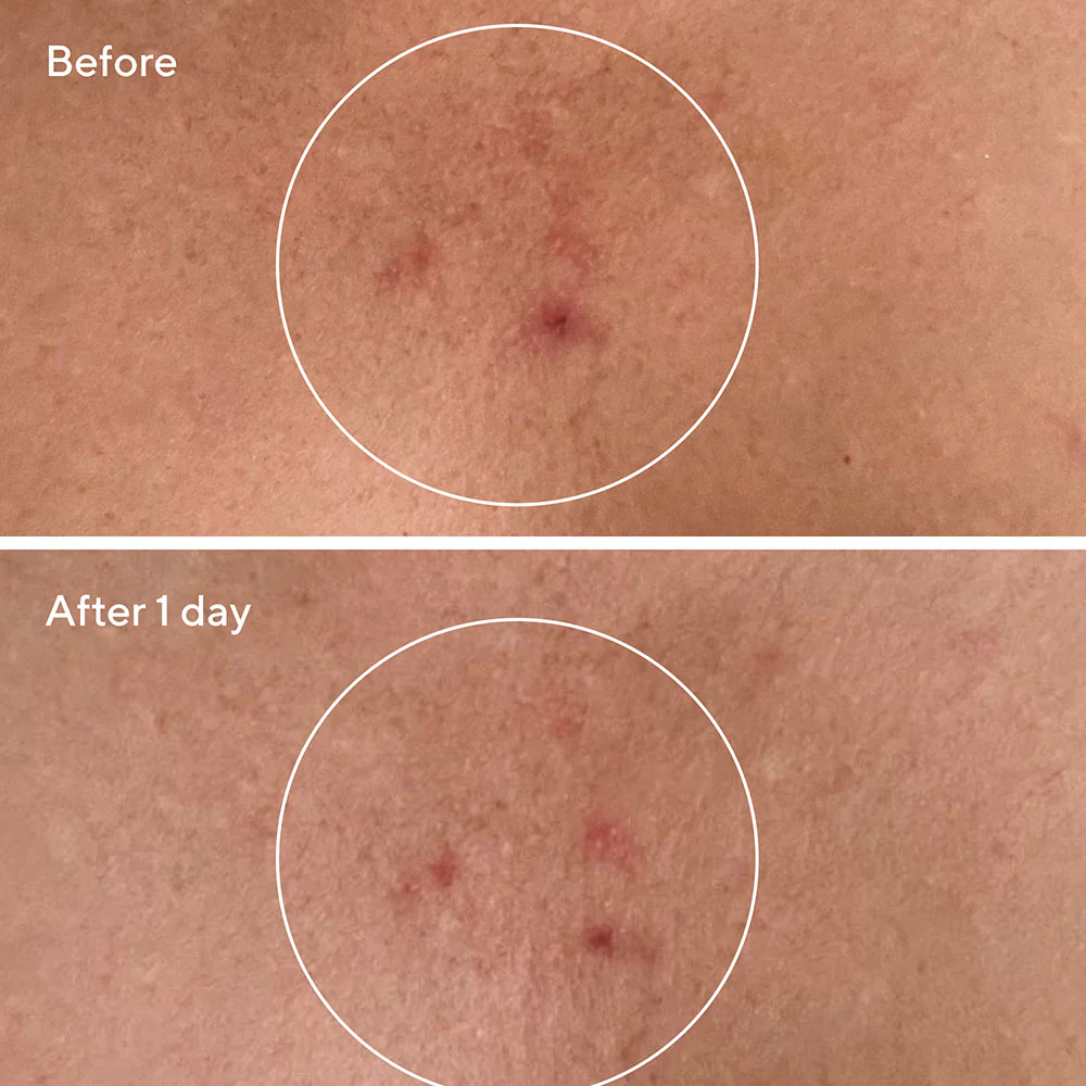 Acne Body Duo Savings Bundle - Image 4