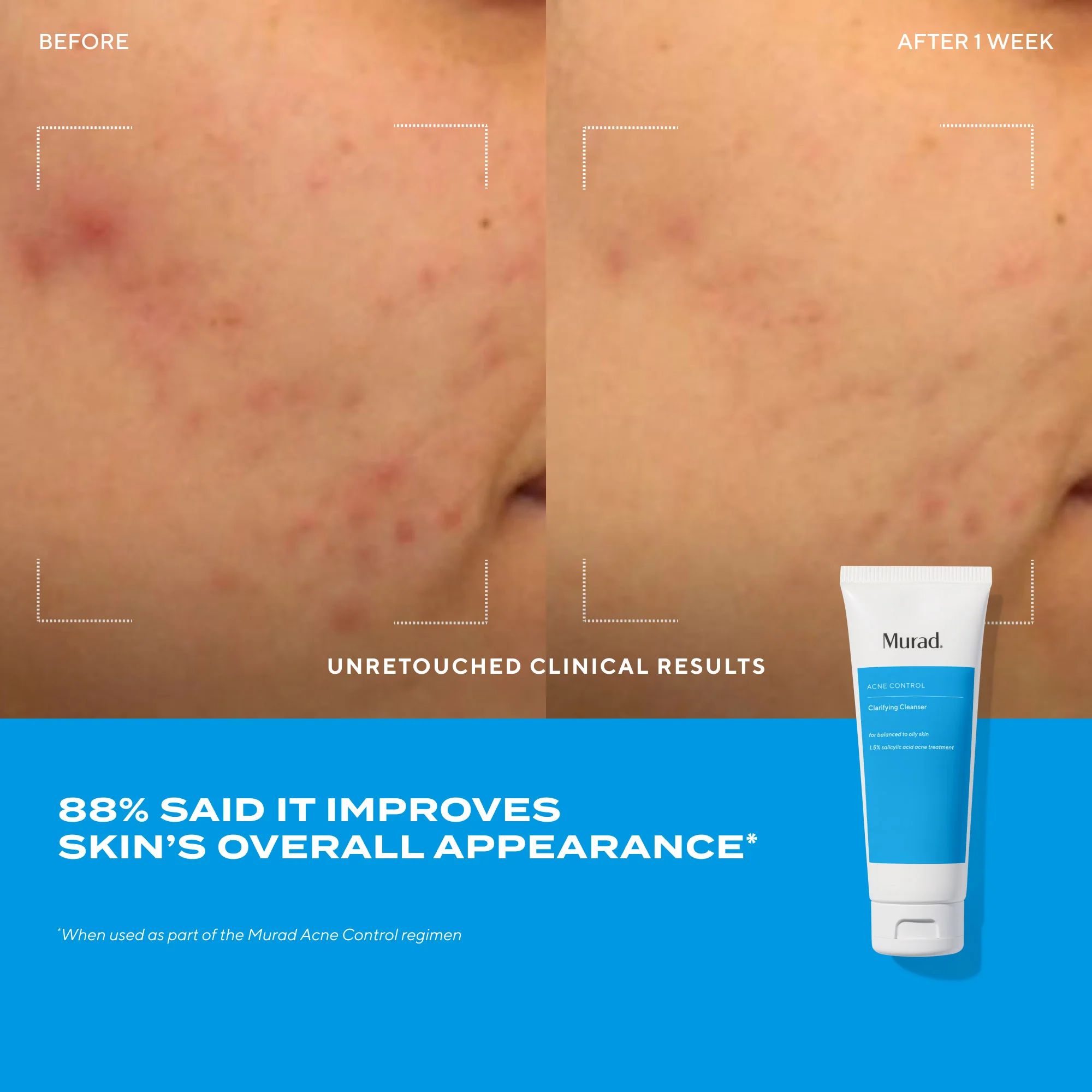 Acne Control Clarifying Cleanser - Image 5