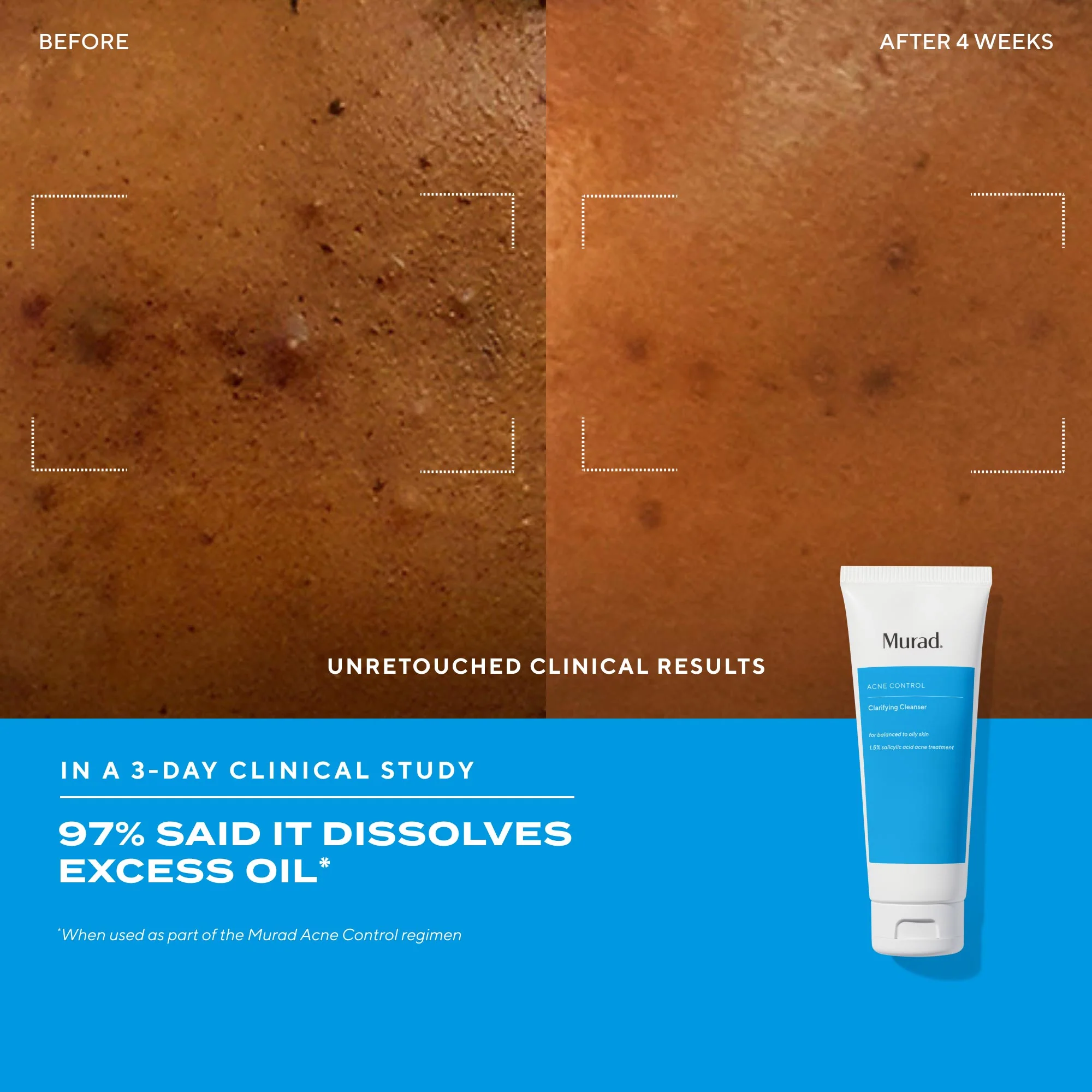 Acne Control Clarifying Cleanser - Image 6