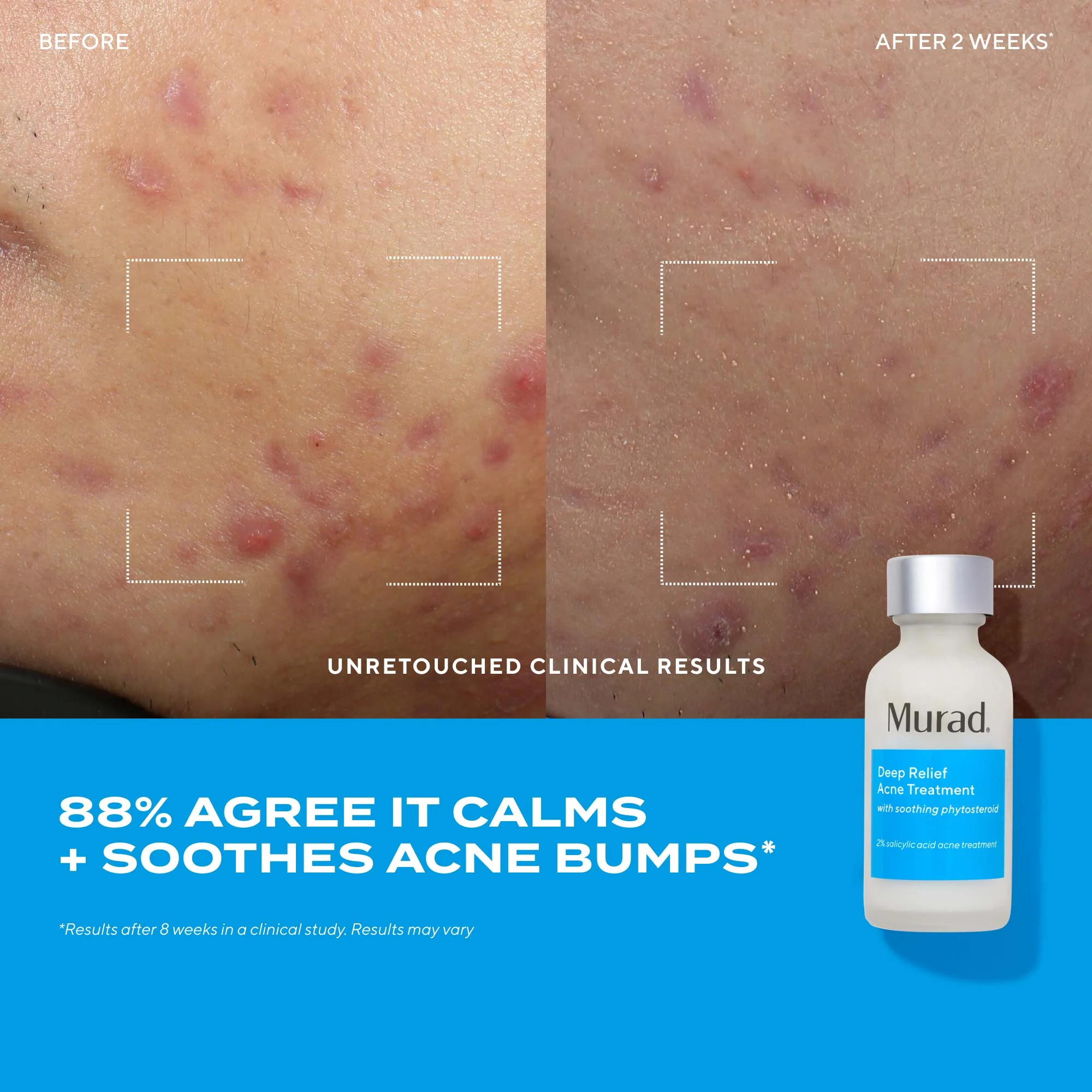 Deep Relief Acne Treatment - Image 3