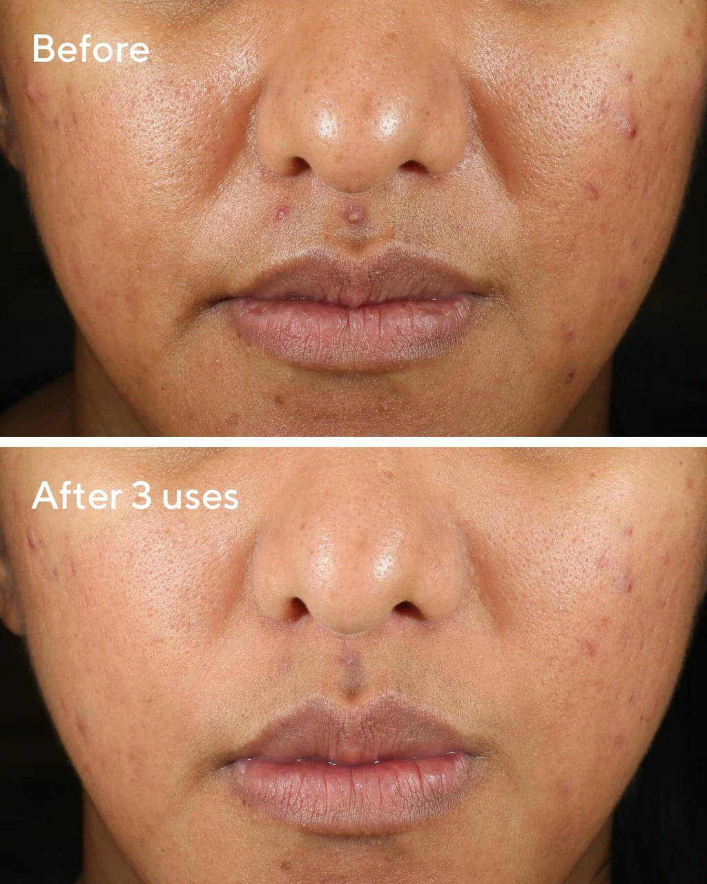 Rapid Relief Acne Sulfur Mask - Image 3